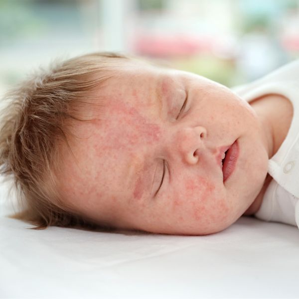 Acné du nourrisson : symptômes, traitement et durée 3