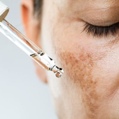 Les secrets de l'hyperpigmentation : ce que votre peau essaie de vous dire