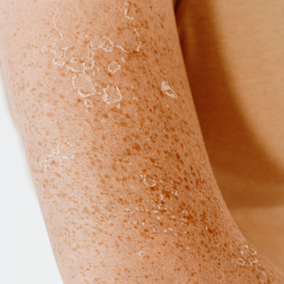 Xérose et sécheresse de la peau : comment apaiser les peaux sensibles ? 5